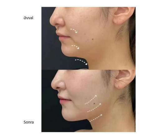 Classys Ultraformer MPT